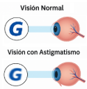 Astigmatismo